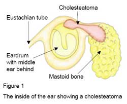 Cholesteatomasurgery
